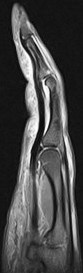 Figure 2 for case Ulnar aspect A3 pulley tear with bowstringing of the flexor tendons